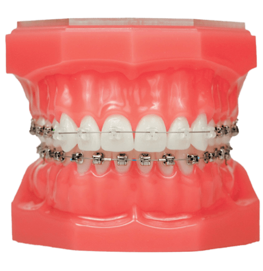 clear braces on model